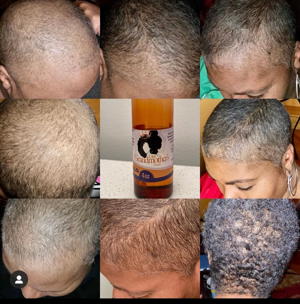 Images shows a chemo warrior who has used our natural hair growth serum after her cancer treatments and gain result with hair growth!